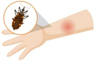 Scabies itch mites can lead to extreme discomfort to the suffering individual by causing sore skin, blisters and secondary infections (Image by Brgfx on Freepik)